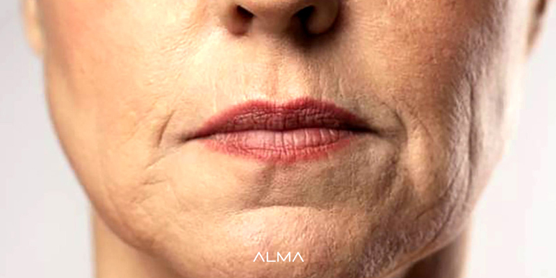 پیری زودرس پوست