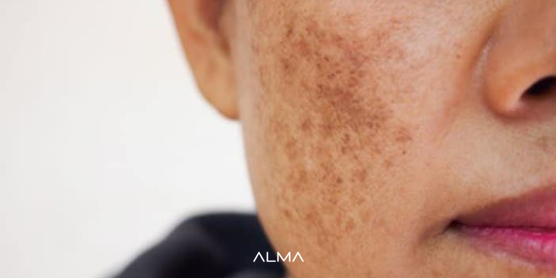 تیرگی و کدری پوست