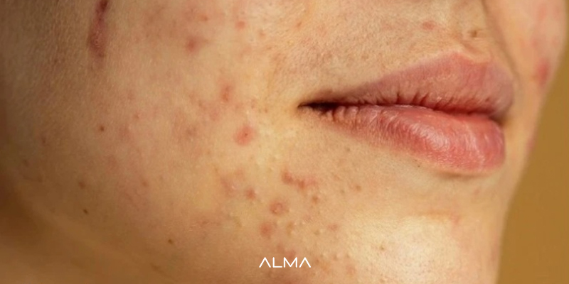 کاهش آکنه و التهاب‌ های پوستی