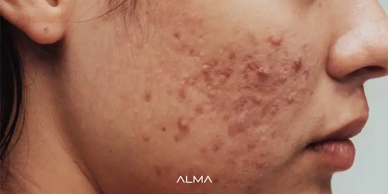 درمان جای جوش و آکنه