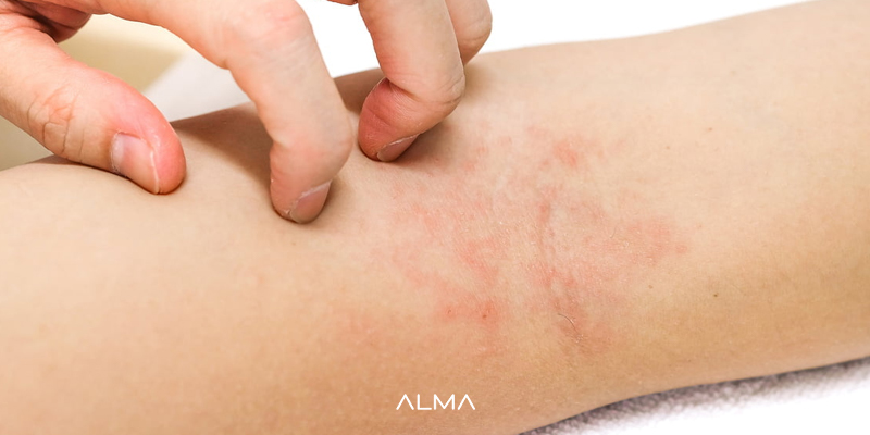 تشدید التهاب 