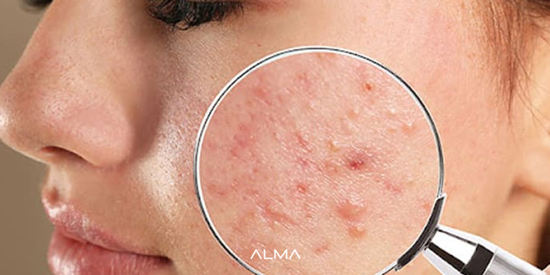 افزایش بروز جوش و آکنه