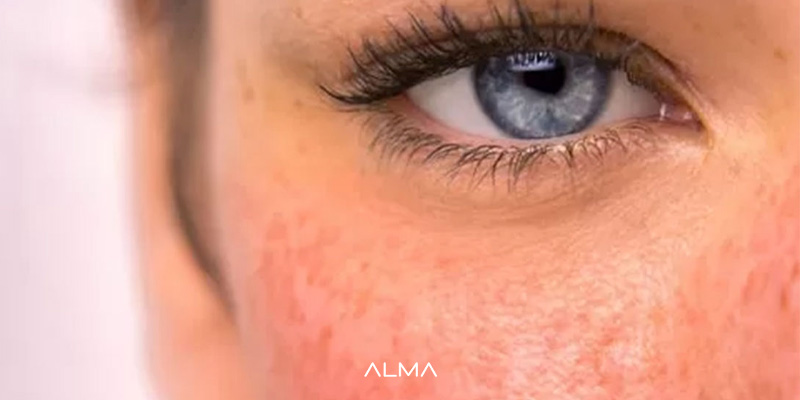 کاهش التهاب