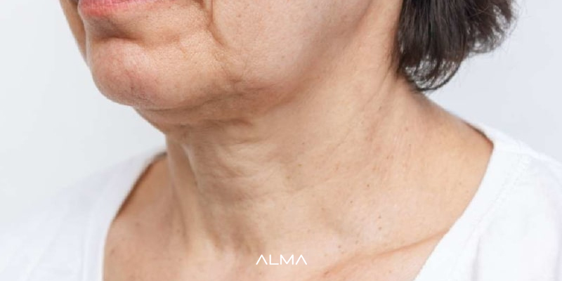 افتادگی پوست