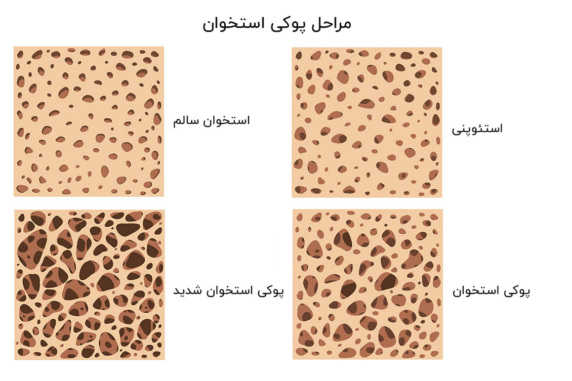  جلوگیری از پوکی استخوان با کوهنوردی